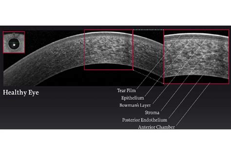 instrument measures thickness of cornea|thickness of cornea.